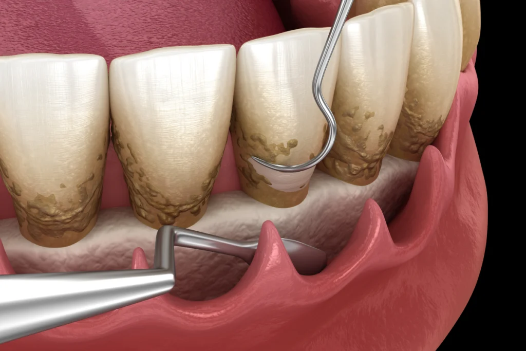 chirurgie assainissement parodontal Soins chirurgicaux des gencives Mediweb - Template 5